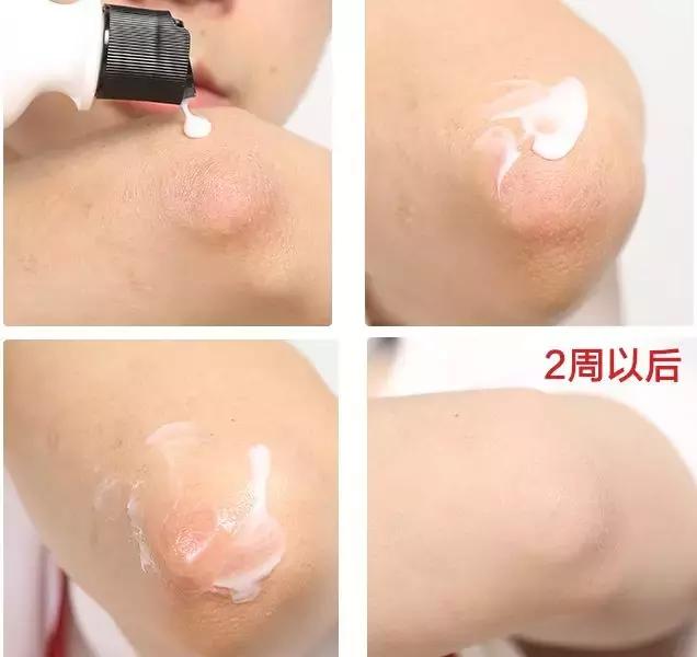 PP、腋下、手肘、三角区发黑暗沉？日本女*爱性**用好物推荐！