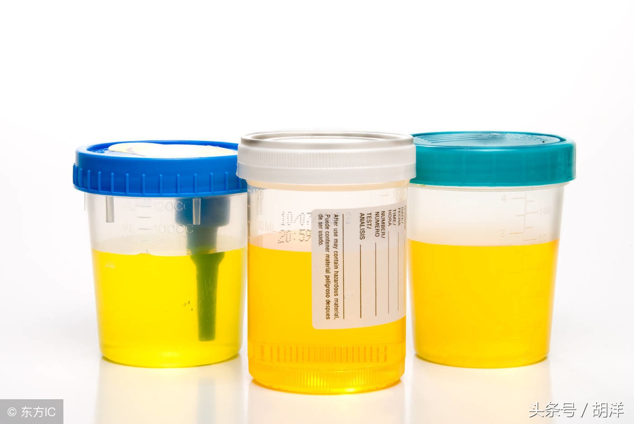 尿里有白细胞怎么回事,尿里有白细胞和细菌怎么回事