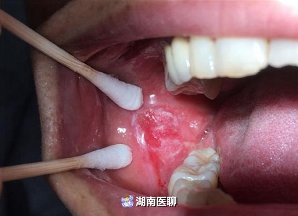 癌性口腔溃疡和普通溃疡区别,口腔溃疡反复发作是什么原因呢