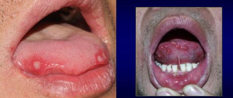 放疗能根治头颈部肿瘤吗,头颈部放疗前口腔处理