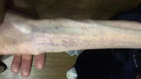 女子减肥脑组织减成60岁,1米7160斤瘦下来的真实案例