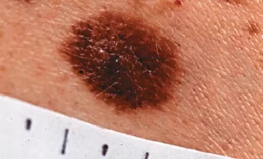 宝宝从小脚上就长黑痣是怎么回事,小孩脚后跟长了颗黑痣越来越大