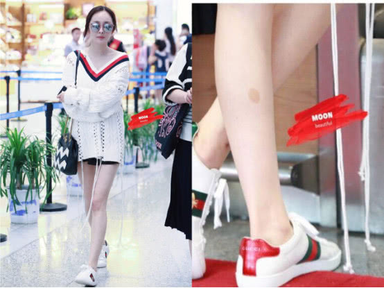 什么情况下胎儿脸上会长胎记,什么原因导致胎儿脸上有胎记