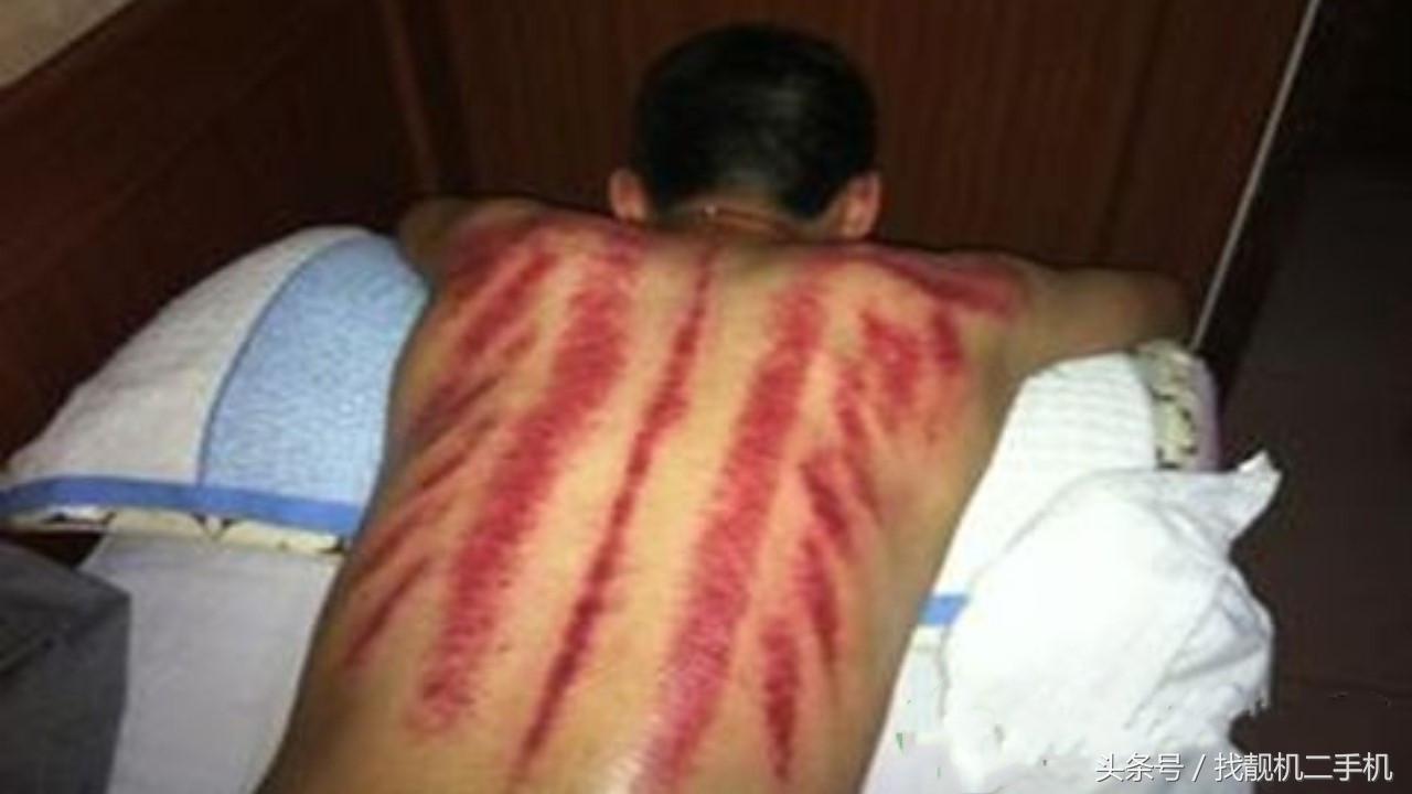 刮完痧第二天排便轻松,后背刮完痧特别轻松