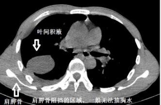 胸水为什么会抽不到,胸水抽了为什么还呼吸困难
