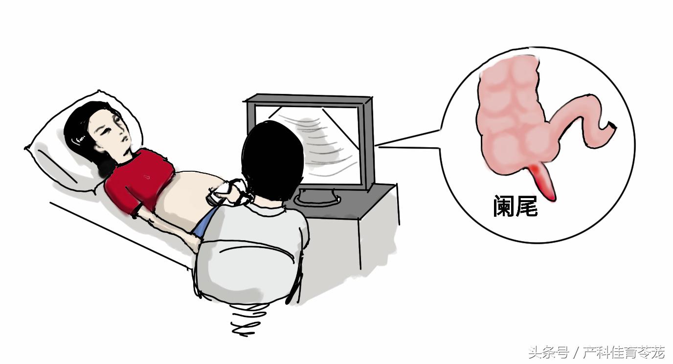 妊娠期急性阑尾炎的处理原则,妊娠期急性阑尾炎最佳治疗方案