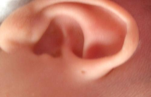 耳朵上方有小洞,耳朵上方有一个小洞代表什么