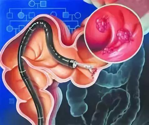 直肠癌和痔疮的便血鉴别,直肠癌与大肠癌的鉴别