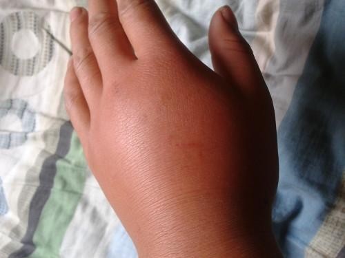 被蜂蜇伤后正确的处理方法是,被蜂蛰伤治疗方法