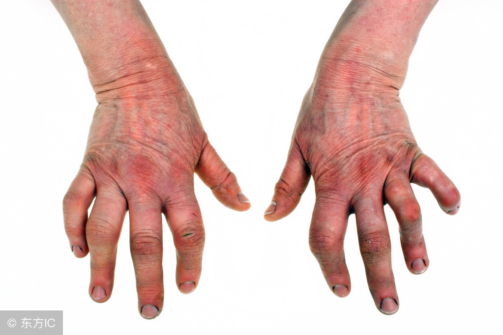 风湿性骨关节炎,骨关节炎与类风湿关节炎哪个严重