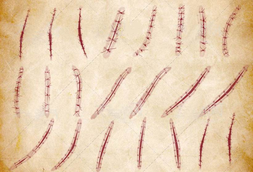 手术切口拆线后可以洗澡么,手术缝合拆线后多久可以洗澡
