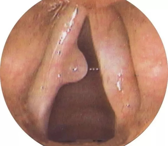 肠息肉和胆囊息肉必须做手术吗,有肠息肉胃息肉胆囊息肉怎么办