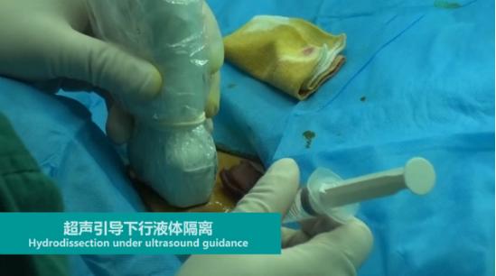 微波消融术，让甲状腺患者康复“加速度”