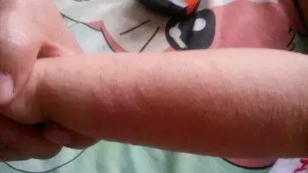 宝宝湿疹康复的全过程,宝宝湿疹不严重也不见好