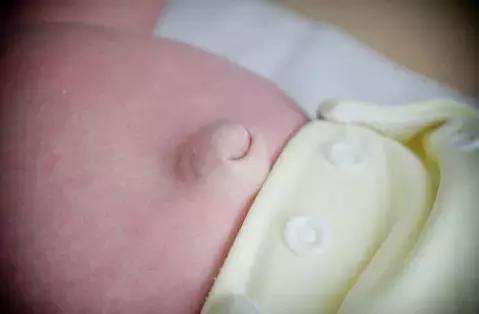 3个月宝宝疝气哭闹怎么办,新生儿腹股沟疝气护理知识