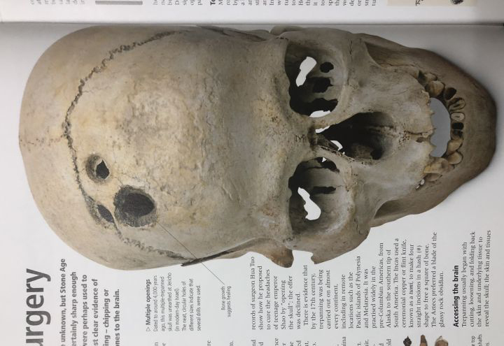 古代人骨折了没有手术怎么办,古代没有手术怎么治疗骨折