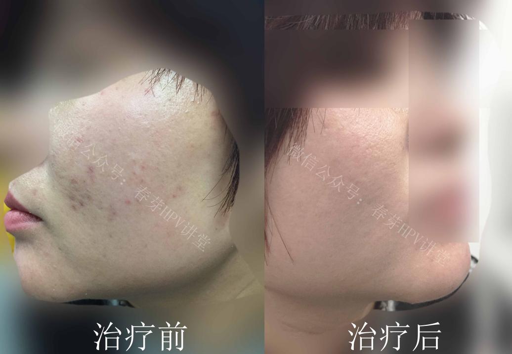 30多岁还起痤疮怎么回事,三十多岁脸上一直长痤疮什么原因