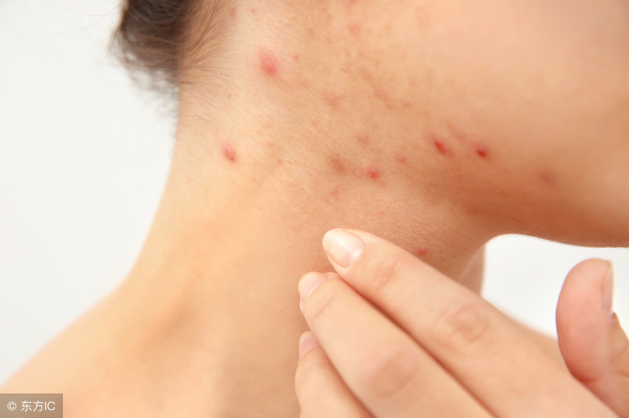 海鲜酒精过敏吃什么缓解过敏症状,酒精过敏碘伏也会过敏吗