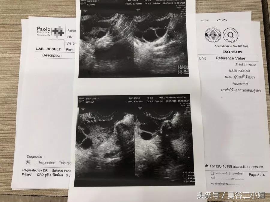 泰国冷冻卵子,泰国冻卵子