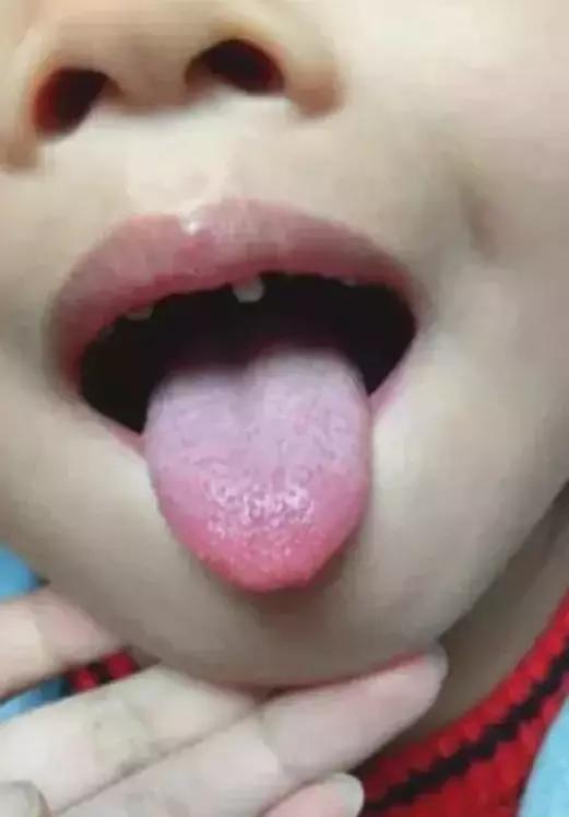 宝宝舌苔变化有什么症状,宝宝舌苔怎么样才是健康的