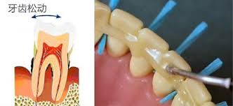 松动的牙齿固定可以整齐吗,松动牙齿固定恢复