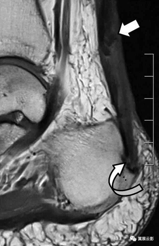 轻微骨裂容易被误诊,临床容易误诊的影像片子