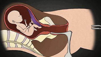 堕胎是杀人吗,堕胎就是杀生