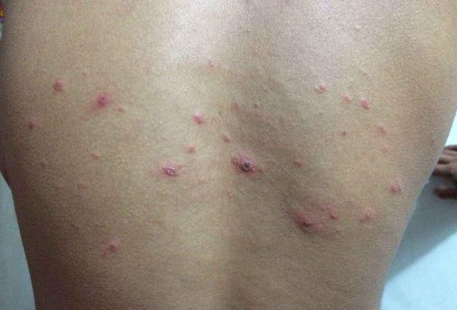 后背油脂粒是螨虫吗,背部螨虫粒和脂肪粒区别