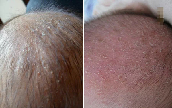 婴儿肌肤总有问题,远离宝宝肌肤问题