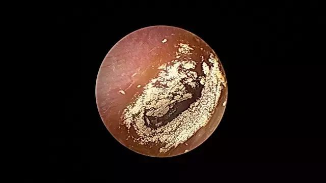 给耳朵滴药水会流到口里吗,给耳朵滴药方法