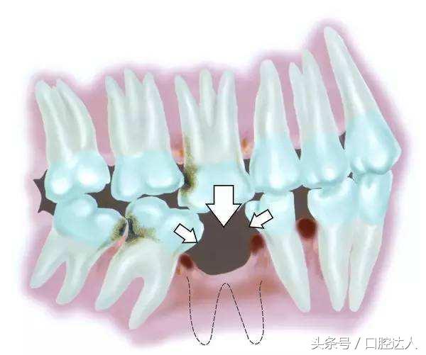 上牙第二颗缺一颗牙不装有影响吗,缺一颗牙能通过矫正牙齿拉过去吗