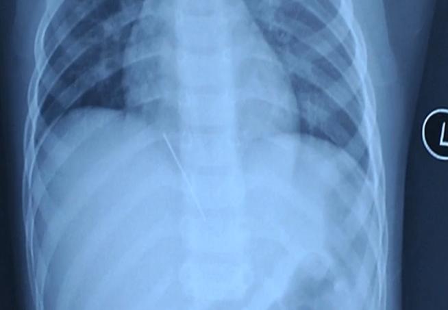 两岁半宝宝体内藏针,两岁儿童缝衣针