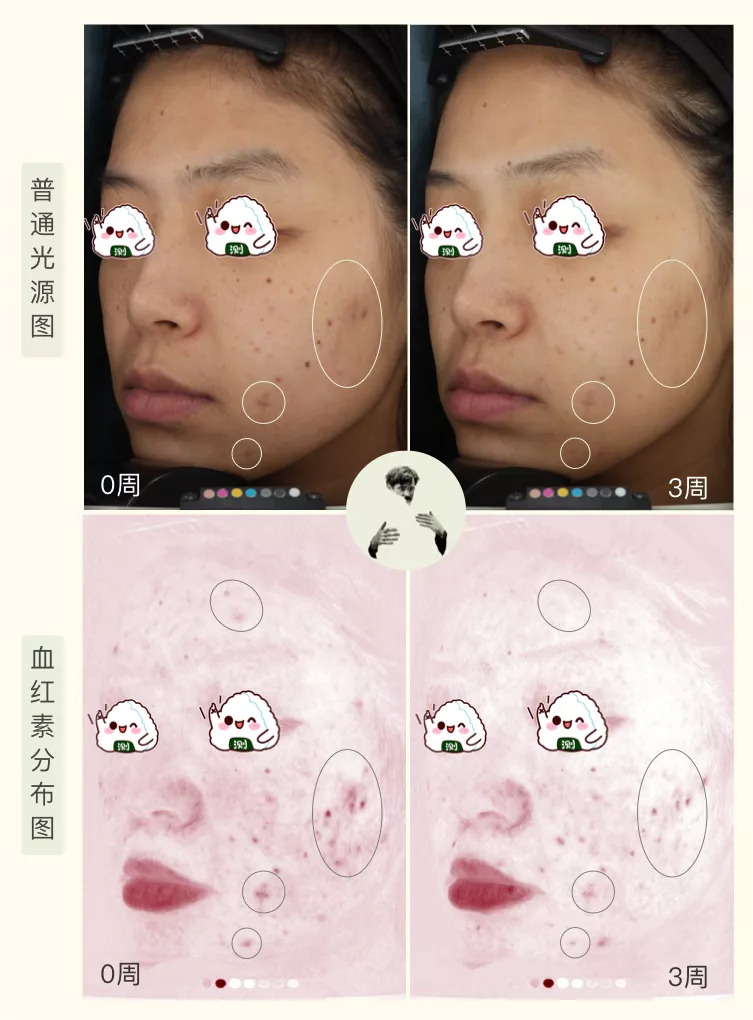 30天花80块去掉陈年老痘印到底有没有可能？