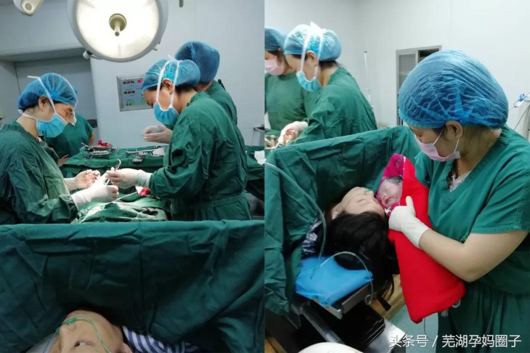 胎儿臀位分娩,怀孕30周胎儿臀位剖腹产