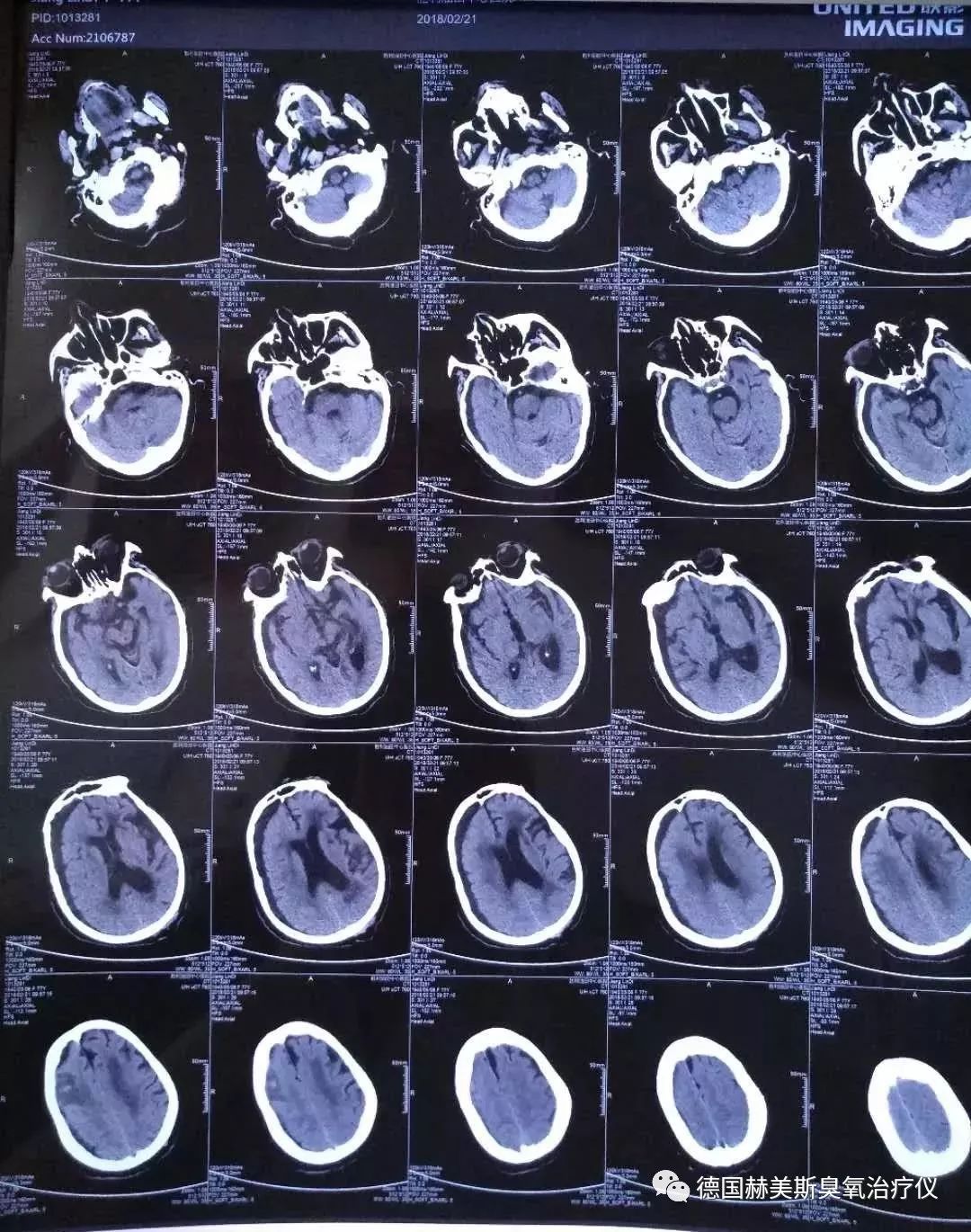 三氧大自血疗法能预防脑梗塞吗,脑萎缩脑梗塞能自愈吗