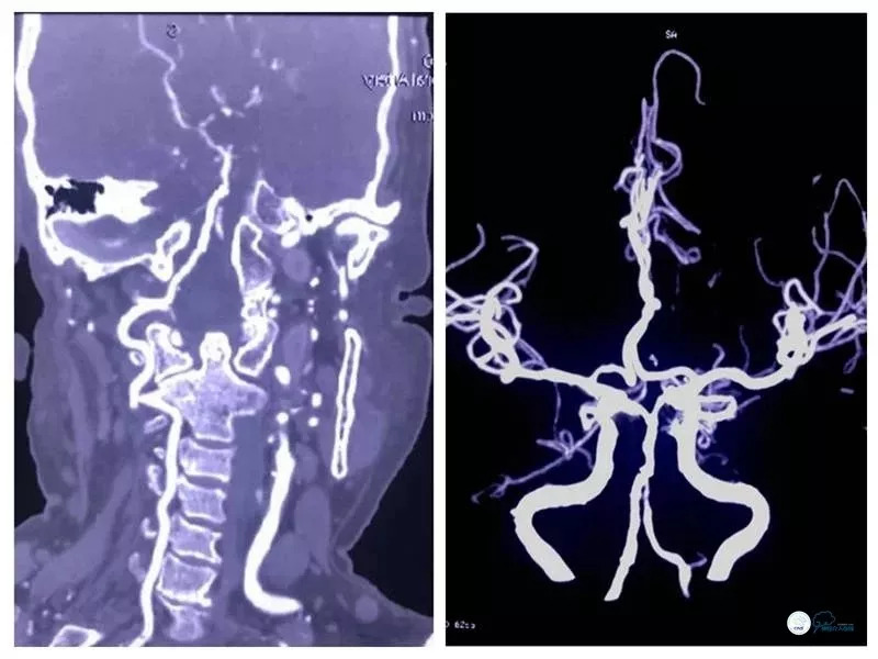 基底动脉重度狭窄介入治疗的风险,椎基底动脉重度狭窄的保守治疗