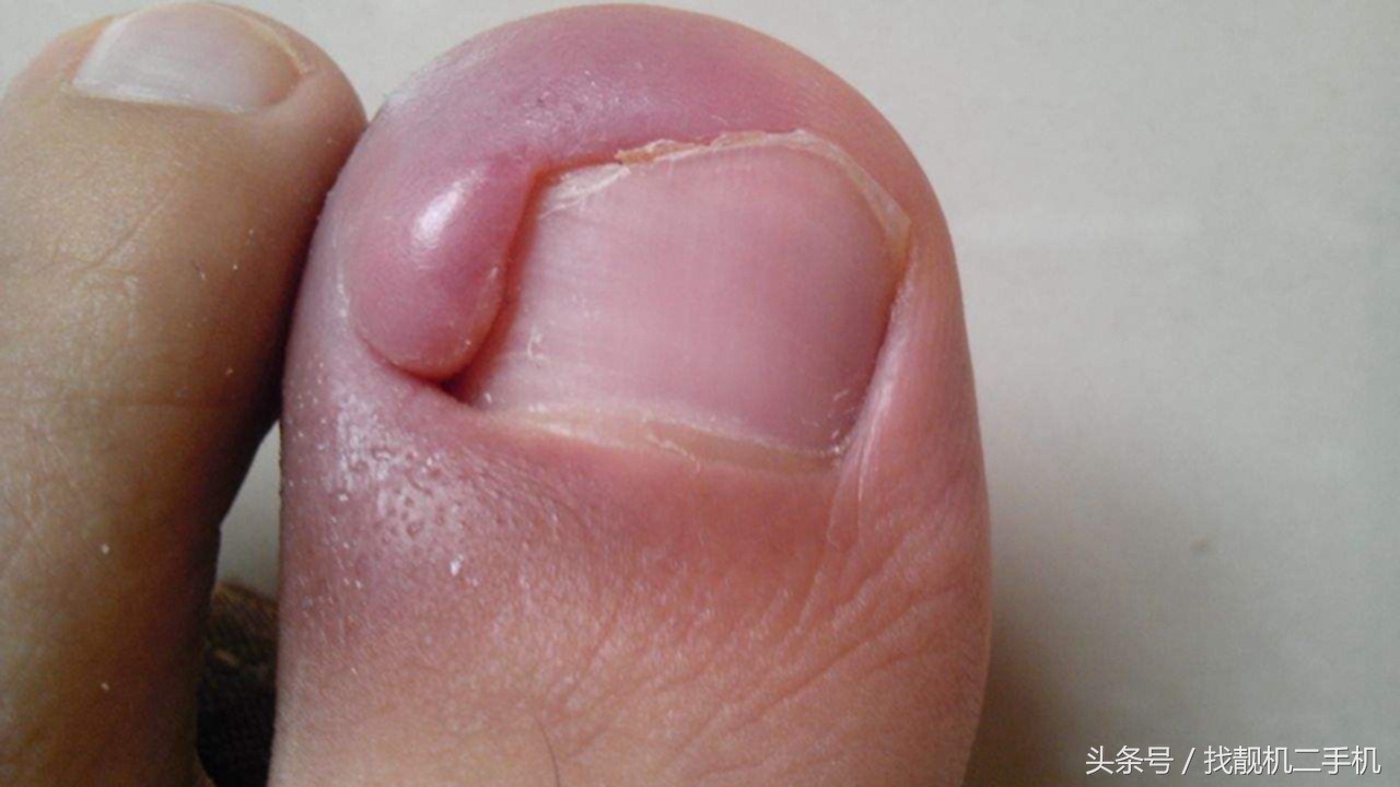 脚指甲长到肉里面，到底要怎么办？