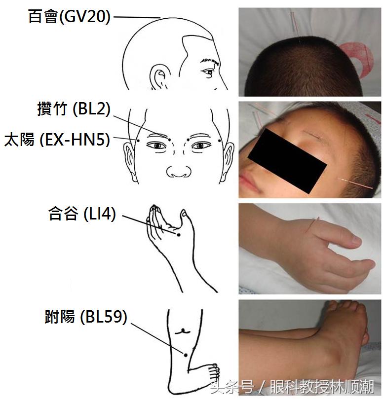 中西医药合璧针灸辅助治疗眼疾
