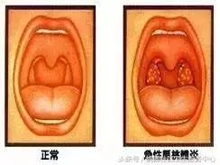 家长们注意了!孩子得了化脓性扁桃体炎怎么办?