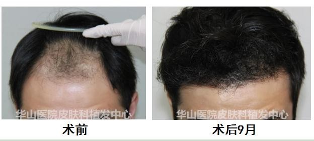 5个原因导致男人脱发,雄激素性脱发能治吗