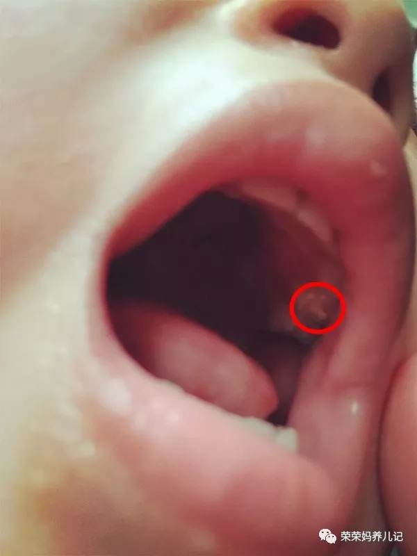 乳牙蛀牙可以不管它吗,孩子乳牙没换就蛀牙了需要补吗