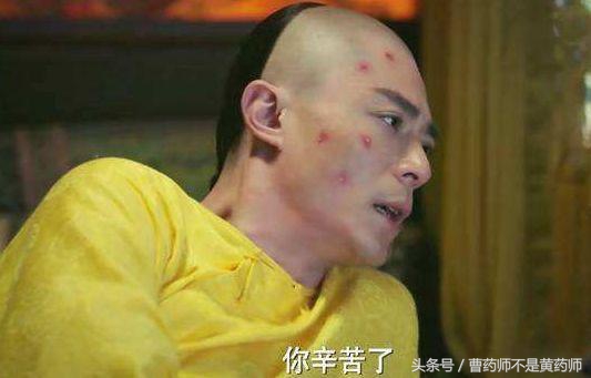 延禧攻略中聂远得疥疮,延禧攻略皇上得疥疮的原因