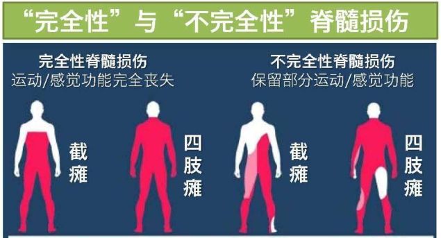 2021干细胞治疗脊髓损伤临床案例,干细胞治疗脊髓损伤最新临床试验
