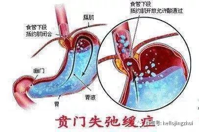 胸口有燃烧的感觉,胸口有团火感觉喉咙有火吃什么药