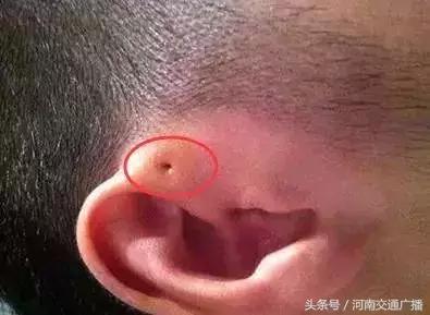 宝宝耳朵长出聪明孔,婴儿耳朵边长了小肉球