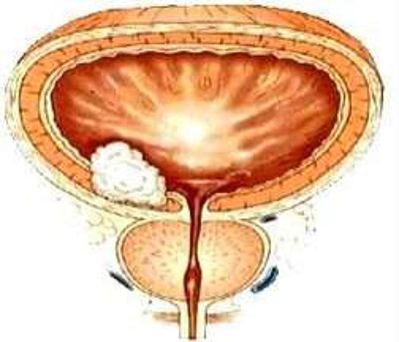 糖尿病的并发症信号,糖尿病并发症的信号是什么