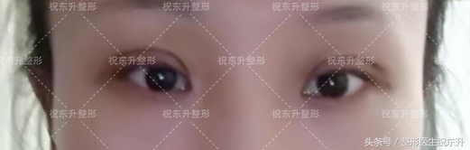 实例：全切双眼皮术后15天变化全程记录