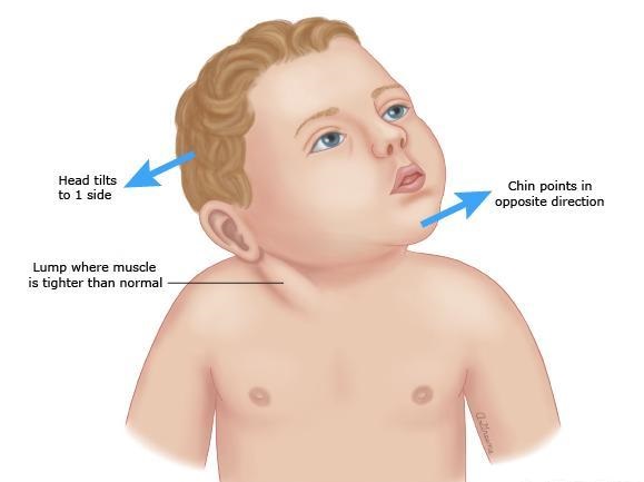 歪脖的症状图片,什么病能引起脖子歪