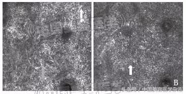 中药调理褐斑一般多久能见效,中药和针灸调理黄褐斑