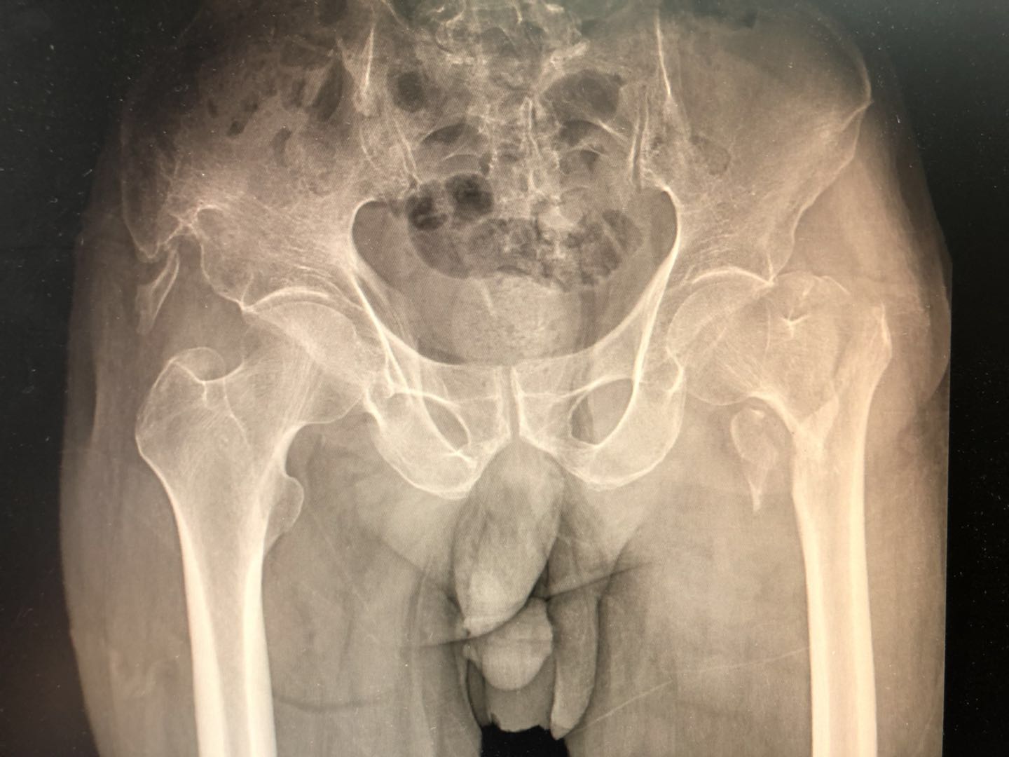 老年人骨折了需要手术吗,老年人胸椎骨折手术治疗风险